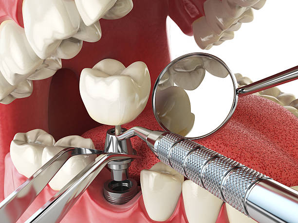 Best Emergency Root Canal Treatment in Groesbeck, OH